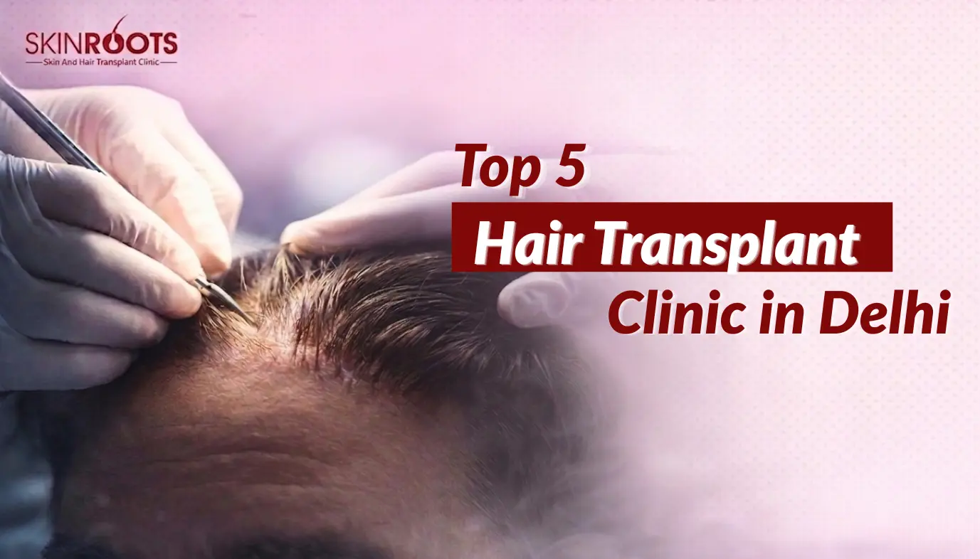 Top 5 Hair Transplant Clinics in Delhi: Expert Comparison Guide